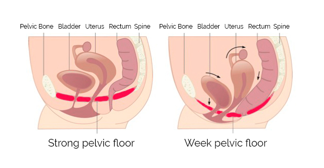 Strengthened Pelvic Floor vs Weak Pelvic Floor